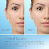 ژل ضدجوش دیفرین مدل آداپالنDifferin Gel Adapalene 0.1%