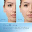 ژل ضدجوش دیفرین مدل آداپالنDifferin Gel Adapalene 0.1%