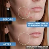 ژل ضدجوش دیفرین مدل آداپالنDifferin Gel Adapalene 0.1%