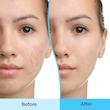 ژل ضدجوش دیفرین مدل آداپالنDifferin Gel Adapalene 0.1%