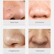 چسب بینی سرسیاه لانبنا-Lanbena nose plants pores strips