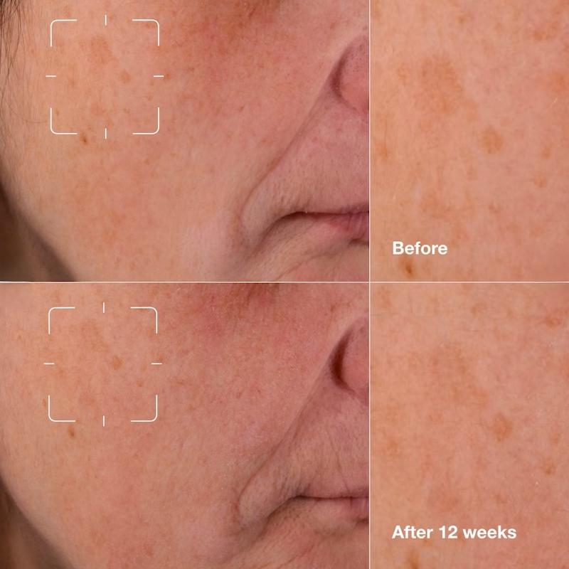 سرم ضد لک کلینیک، سرم کلینیک، Even Better Clinical، سرم Even Better Clinical، سرم روشن کننده کلینیک، سرم ضد لک صورت، سرم رفع لک صورت، سرم لک صورت، سرم ضد تیرگی پوست، سرم روشن کننده پوست، سرم شفاف کننده پوست، سرم یکدست کننده رنگ پوست، سرم جای جوش، سرم رفع جای جوش، درمان لک صورت، کاهش لک پوستی، رفع لک ناشی از آفتاب، رفع لک ناشی از جوش، سرم پوست حساس، سرم پوست چرب، سرم پوست خشک، سرم پوست مختلط، سرم آبرسان و روشن کننده، سرم ضد لک قوی، سرم روشن کننده حرفه‌ای، سرم مراقبت پوست، محصولات مراقبت پوستی کلینیک، سرم کلینیک اصل، سرم کلینیک اورجینال، سرم خارجی ضد لک، سرم صورت حرفه‌ای، سرم ضد کدری پوست، سرم شاداب کننده پوست، سرم برای پوست کدر، سرم برای لک تیره، سرم ضد پیری و روشن کننده، سرم ضد لک روزانه، سرم ضد لک پوست حساس، سرم یکنواخت کننده پوست، سرم ضد لک و جای جوش، سرم مراقبت پوست صورت، سرم درخشان کننده پوست، سرم ضد لک کلینیک Even Better، سرم ضد لک و روشن کننده، سرم صورت بدون چربی، سرم فاقد عطر، سرم مناسب انواع پوست، سرم ضد لک صورت کلینیک، سرم کاهش تیرگی پوست، روشن کننده جای جوش، روشن کننده پوست صورت، ضد لک پوست، درمان تیرگی پوست، سرم ضد لک آمریکایی، محصولات Clinique، سرم پوست کلینیک، سرم شفاف کننده صورت، سرم تخصصی ضد لک، سرم مراقبت روز و شب، سرم کاهش لک‌های تیره، سرم ضد لک و آبرسان، سرم پوست حساس و مستعد لک، سرم صورت کلینیک اصل، سرم ضد لک حرفه‌ای کلینیک، سرم روشن کننده جای آکنه، سرم ضد لک و ضد تیرگی، سرم Even Better Clinical Dark Spot Clearing Serum, Clinique Even Better Serum, dark spot serum, brightening serum, skin tone correcting serum, hyperpigmentation serum, acne mark serum, dark spot corrector, skin brightening serum, uneven skin tone serum, discoloration serum, glow serum, radiance serum, skincare serum, facial serum, clinique skincare, oil free serum, dermatologist tested serum, sensitive skin serum, spot correcting serum, pigmentation serum, complexion correcting serum, daily brightening serum, anti dark spot serum, advanced brightening serum, healthy glow serum, even skin tone serum, clinique dark spot serum, clinical serum, professional skincare serum, anti blemish serum, post acne mark serum, brightening skincare, skin clarity serum, luminous skin serum, dark spot treatment serum, corrective serum, facial brightening treatment