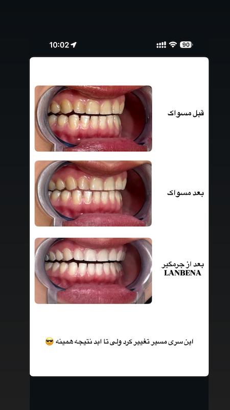 اسنس سفیدکننده دندان لانبنا LANBENA Teeth Whitening Essence حجم ۱۰ میل