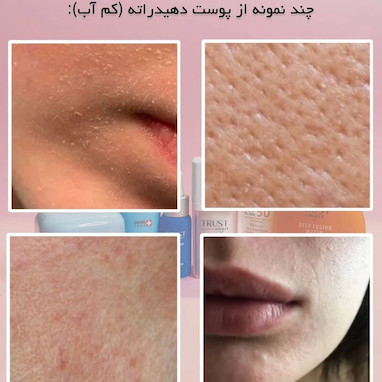 فرق پوست خشک و پوست دهیدراته چیست؟