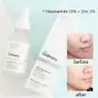 سرم نیاسینامید و زینک اوردینری The Ordinary ضد جوش اصل 30 میل