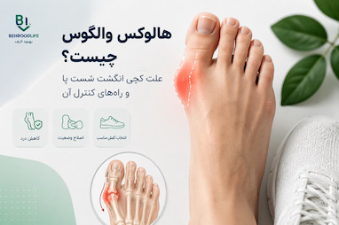 هالوکس والگوس چیست؟ علت کجی انگشت شست پا و راه‌های کنترل آن