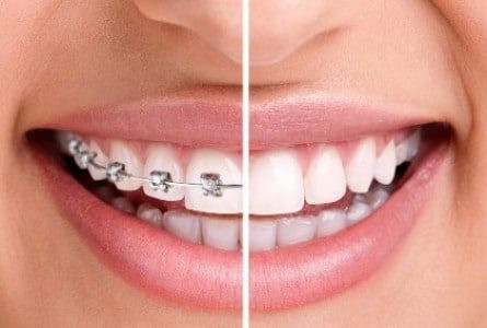 روش های موثر برای نگهداری و مراقبت از دندان های ارتودنسی شده