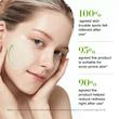 پد تسکین‌دهنده قرمزی آنوا | Azelaic 10 Hyaluron Redness Soothing Pad