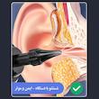 گوش پاک‌کن برقی مدل  Remover