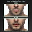 زاویه ساز فک رادیس فیت مدل Full Weight  بسته شش عددی