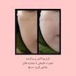 کرم بوتاکس و پرکننده اصل، فوری و قوی صورت طبیعی و گیاهی، پرکننده چین و چروک، حجم دهنده گونه و صورت با اثر فوری و سریع با عصاره های گریدA+++