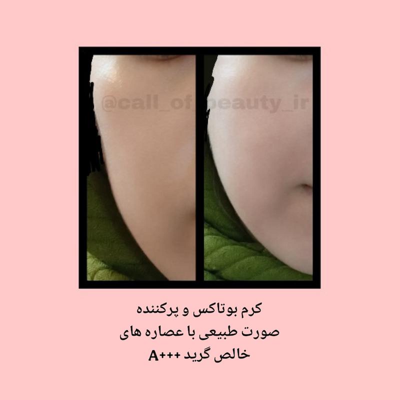 کرم بوتاکس و پرکننده اصل، حجم دهنده صورت، فوری و قوی صورت طبیعی و گیاهی، حجم دهنده گونه و صورت با اثر فوری و سریع با عصاره های گریدA+++
