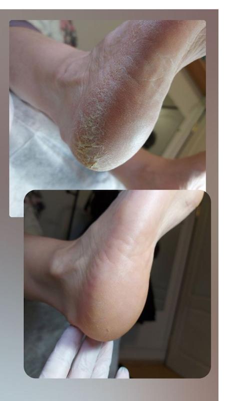 پک سلامت پا (سنگ پا و جوراب سیلیکونی)