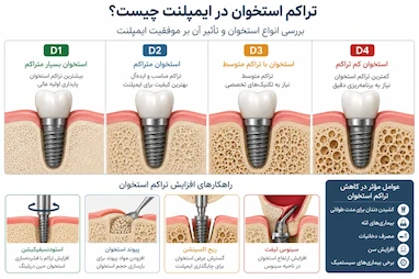 تراکم استخوان در ایمپلنت چیست؟ چرا کیفیت استخوان مهم‌تر از چیزی است که فکر می‌کنید؟