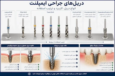 راهنمای کامل دریل‌های جراحی ایمپلنت | انواع دریل، کاربرد و ترتیب استفاده