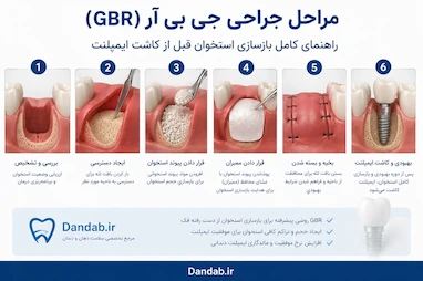 مراحل جراحی جی بی آر (GBR)؛ راهنمای کامل بازسازی استخوان قبل از کاشت ایمپلنت