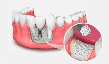 پیوند استخوان در ایمپلنت چیست؟ راهنمای کامل انواع Bone Graft، کاربردها و مراحل درمان