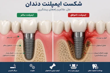 چه عواملی باعث شکست ایمپلنت دندان می‌شوند؟ بررسی علل، پیشگیری و نقش کیفیت استخوان