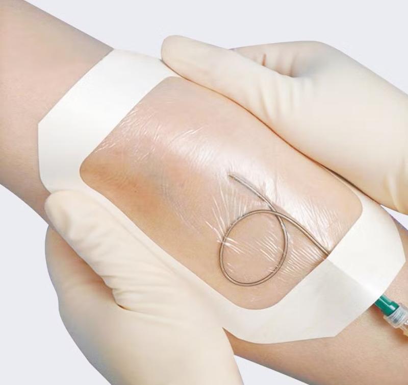 چسب انژیوکت شفاف – ثابت نگه‌داشتن کانولا با دید مستقیم محل تزریق