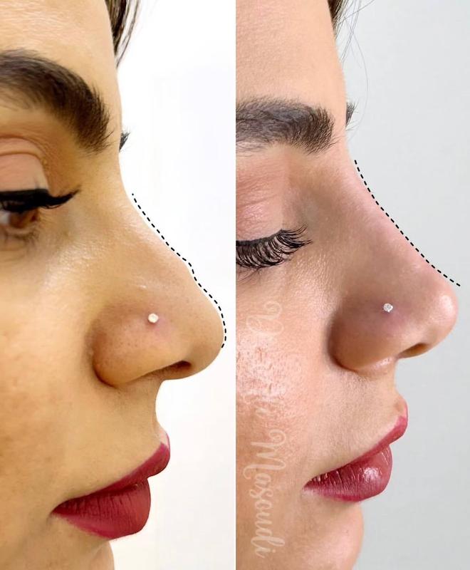 فیلر بینی
