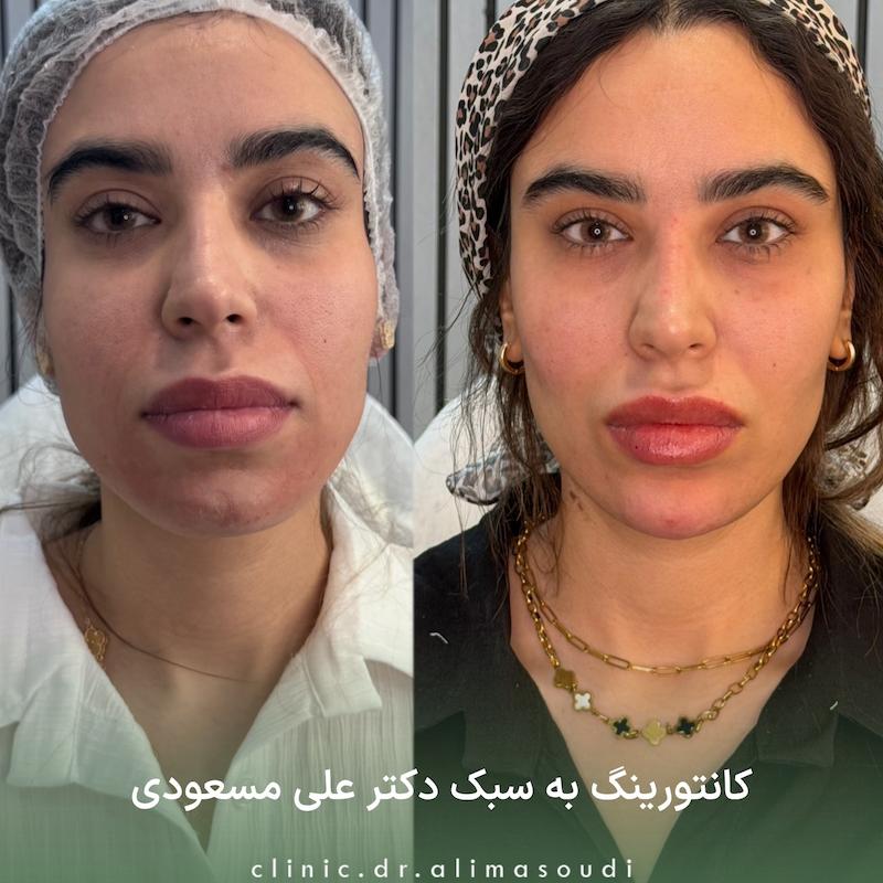 کانتورینگ پکیج نقره ای