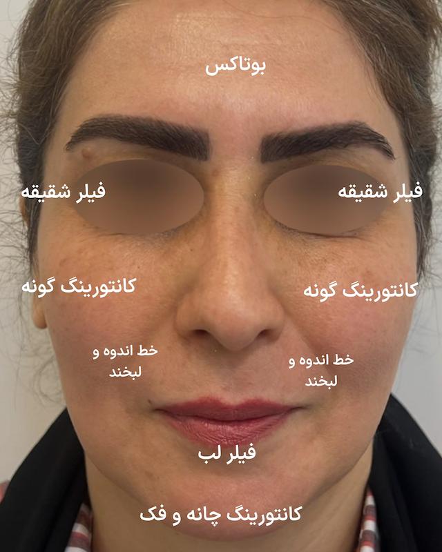 کانتورینگ پکیج الماس