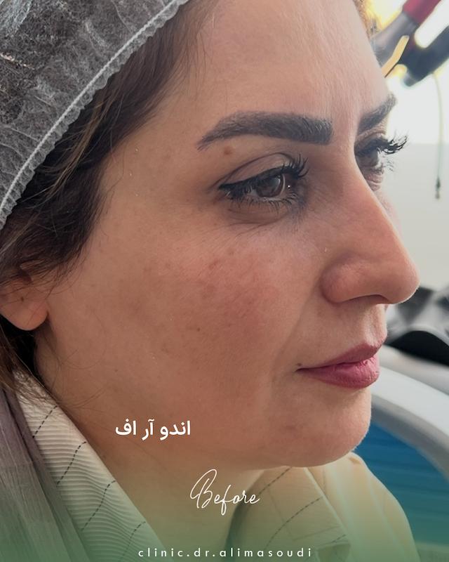 کانتورینگ پکیج الماس