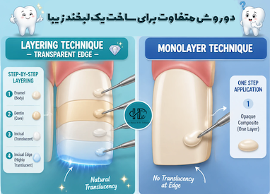 کامپوزیت لبه شفاف ( layering) بهتر است یا معمولی؟