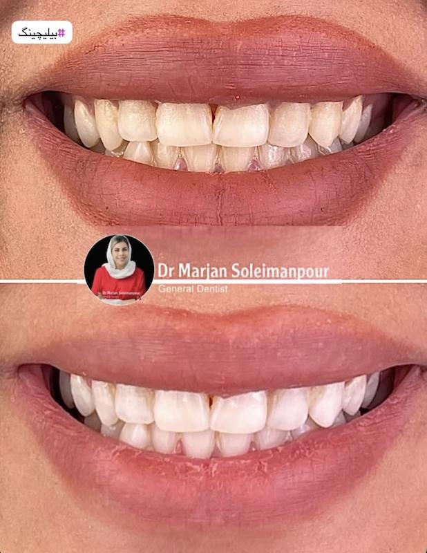 بیلیچینک در خانه