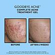 درمان جوش و جای جوش پیتر توماس Acne Spot & Area Treatment by Peter Thomas Roth