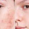تونر ضد جوش پوست صورت دکتر جی تونا Charcoal مناسب برای پوست چرب حجم 125 میلی‌لیتر