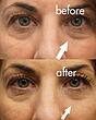 کرم دور چشم جوانساز All About Eyes کلینیک فول سایز حجم 15میل