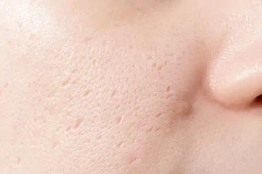 بهترین روش های پوشاندن فرو رفتگی جای جوش