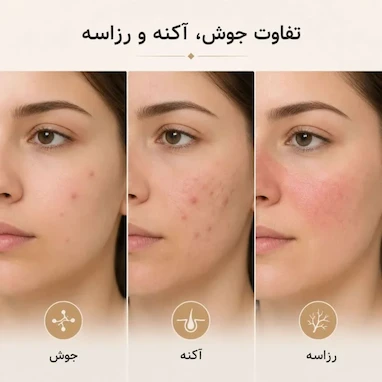 تفاوت جوش، آکنه و روزاسه