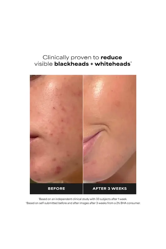 لایه‌بردار ۲٪ BHA پائولاز چویس | Paula’s Choice Skin Perfecting 2% BHA Liquid Exfoliant