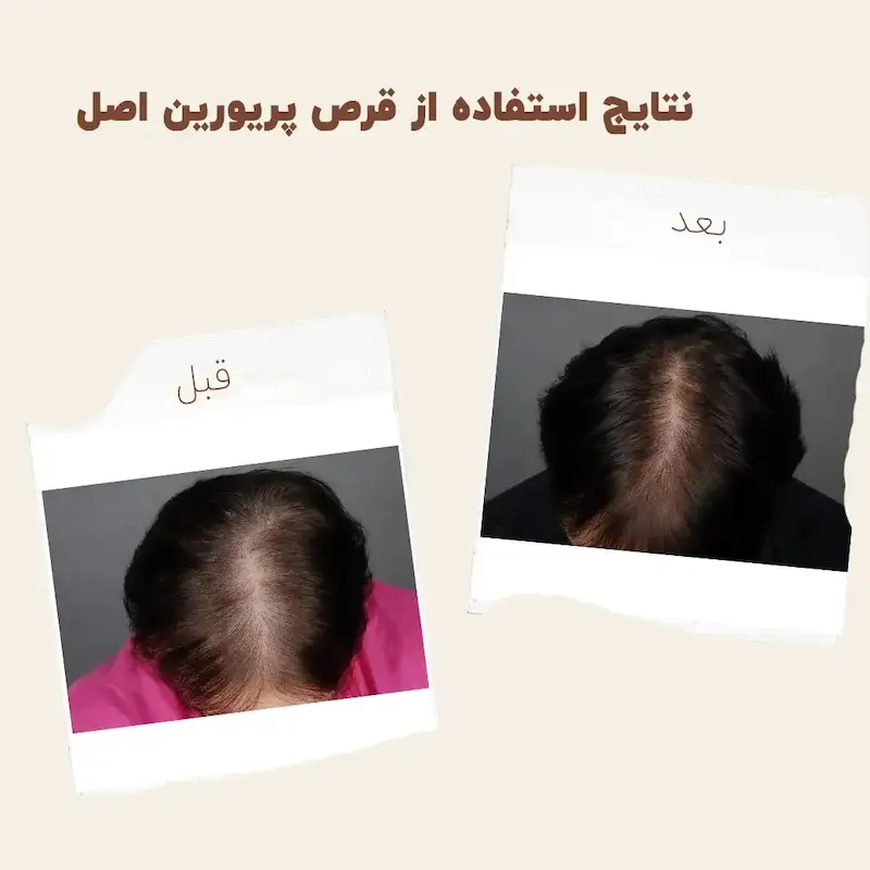کپسول پریورین بایر ضدریزش هورمونی و ارثی آلمانی