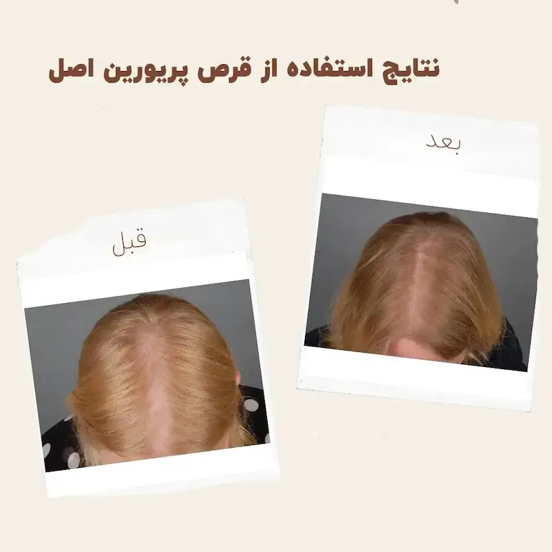 کپسول پریورین بایر ضدریزش هورمونی و ارثی آلمانی