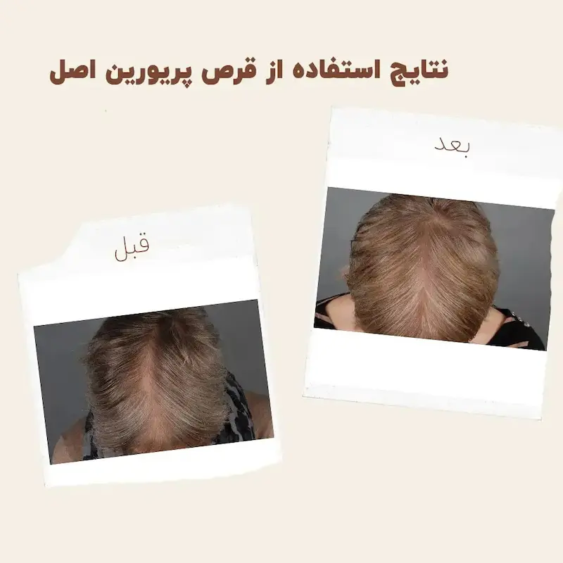 کپسول پریورین بایر ضدریزش هورمونی و ارثی آلمانی