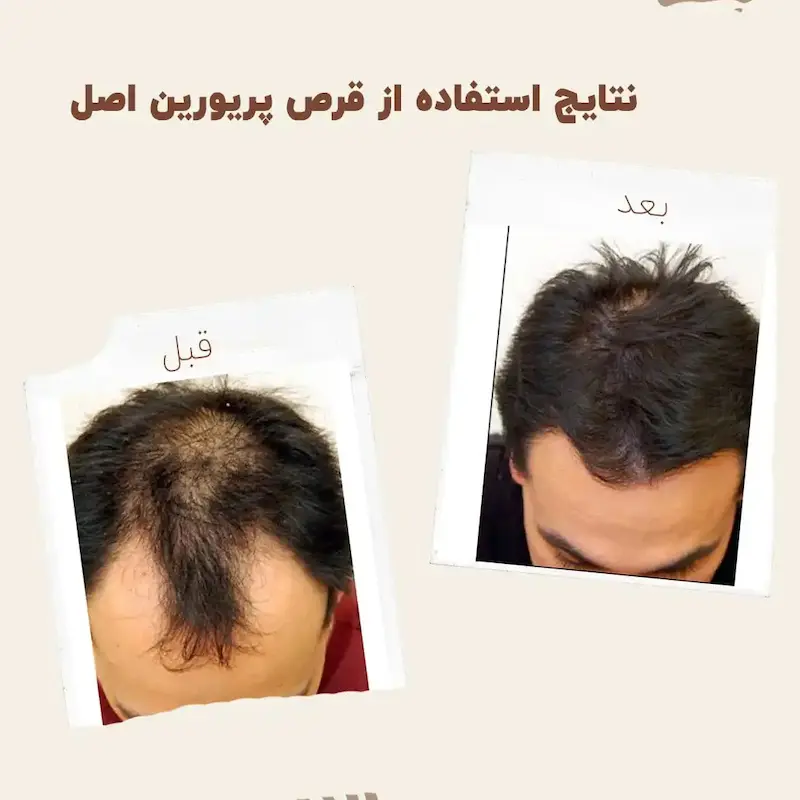 کپسول پریورین بایر ضدریزش هورمونی و ارثی آلمانی