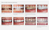 بلیچینگ هوم اپال سنس الترادنت - Ultradent Opalescence PF