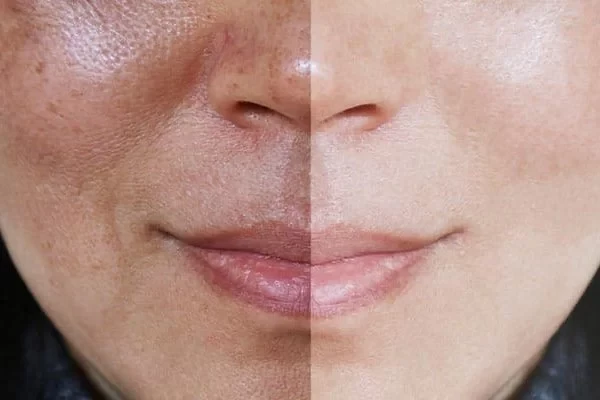 چرا پوستم تیره می‌شه؟ ۱۰ علت اصلی و راه‌حل آن