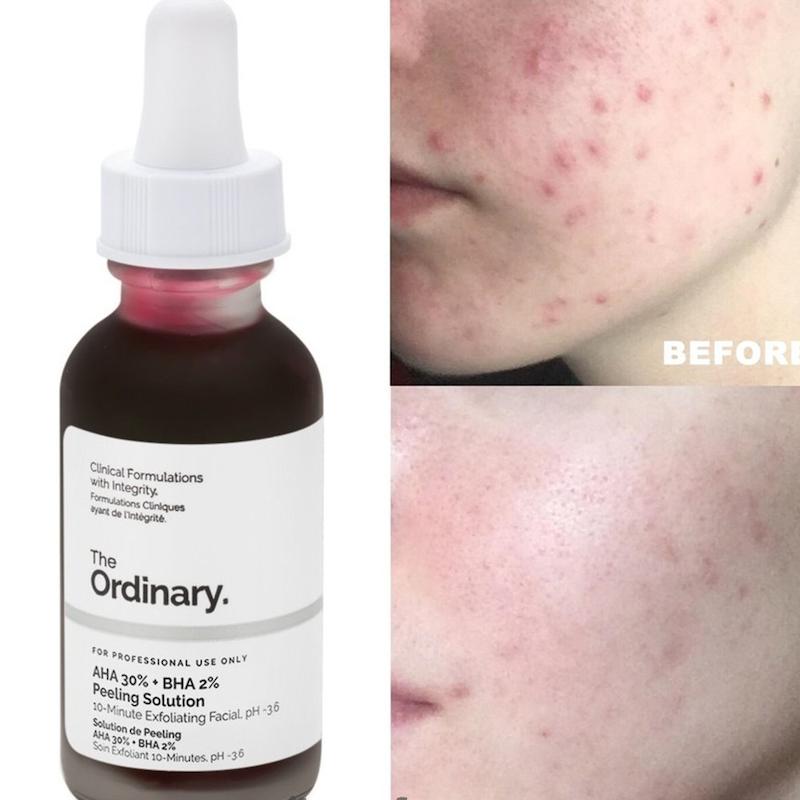 سرم پیلینگ و لایه بردار اوردینری حجم 30 میل The Ordinary AHA 30% BHA 2% Peeling Solution 30mL