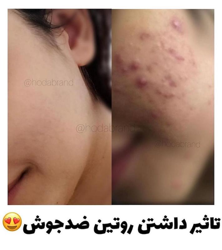 پک ضدجوش تخصصی بیوآکوا