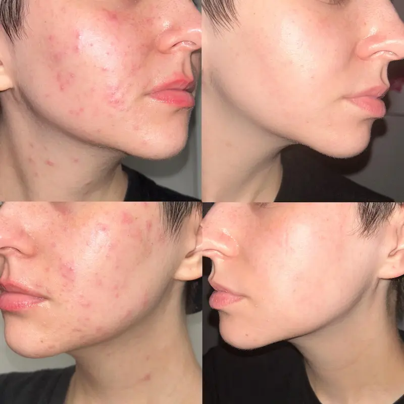سرم ضدجوش و‌ قزمزی آزلائیک اسید ٪10+ و هیالورون آنوا