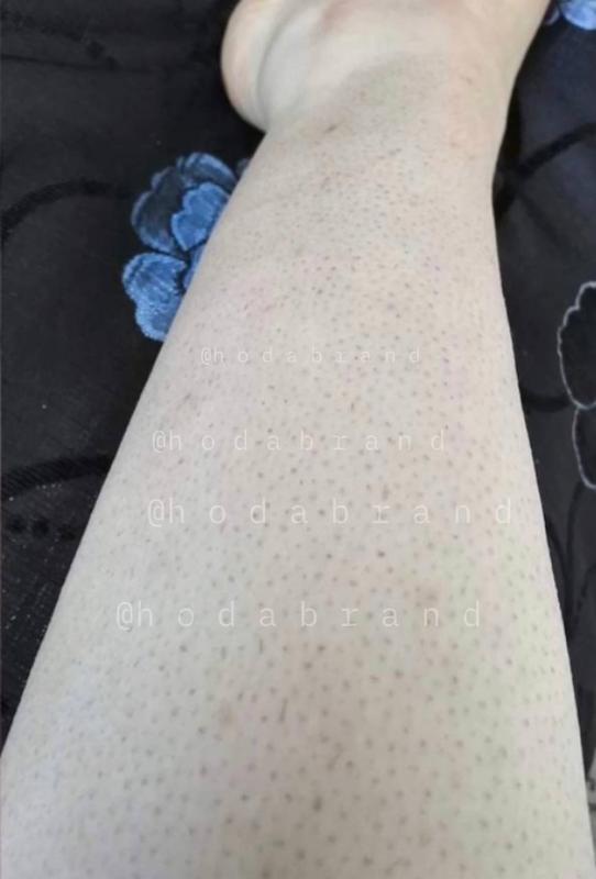 شوگر اسکراب میوه ای رفع پوست مرغی و موی زیر پوستی