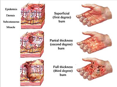 پاورپوینت سوختگی و اقدامات پرستاری