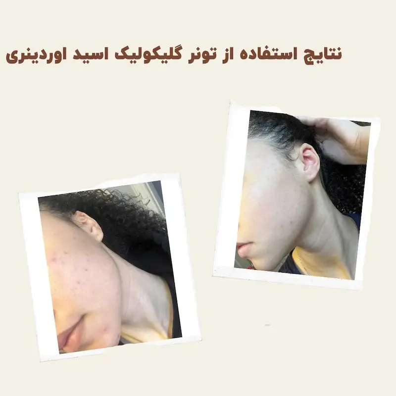 تونر لایه بردار و روشن کننده گلیکولیک اسید اوردینری | The Ordinary Glycolic Acid 7% Toning Solution خریداری شده از سفورا دبی