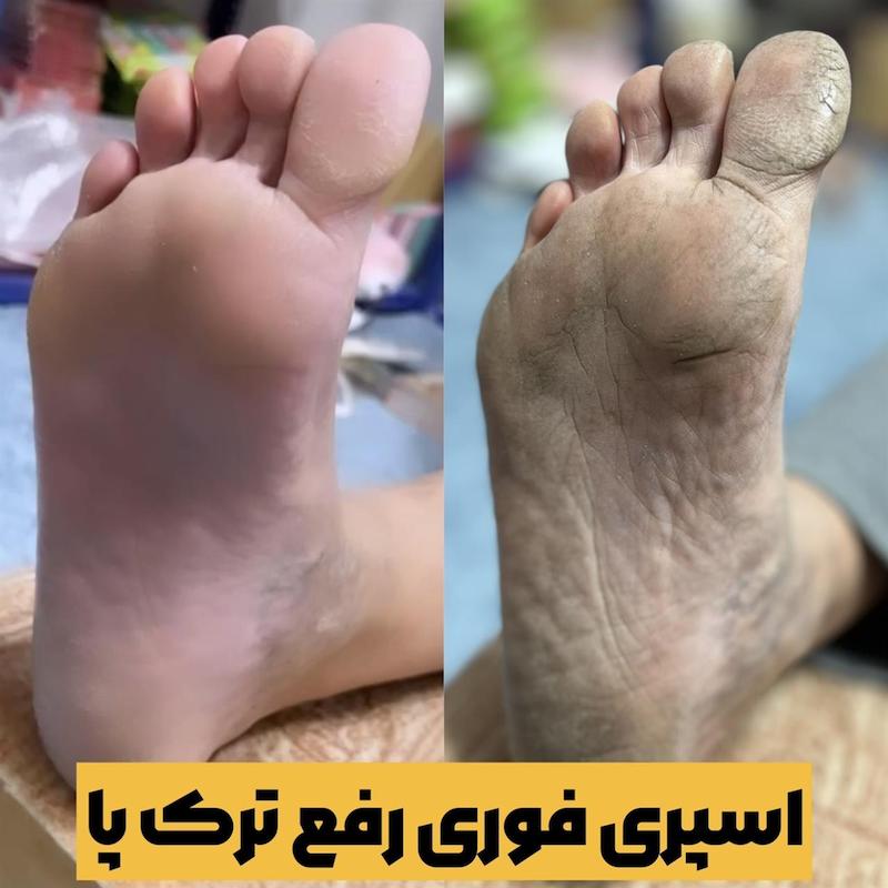 اسپری فوری جادویی ترک پا 