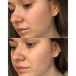 تونر آبرسان و تسکین دهنده سنتلا کوزارکس فاقد الکل Cosrx Centella Water Alcohol-Free Toner