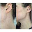 تونر لایه بردار درمانی، آبرسان و روشن کننده AHA و BHA کوزارکس Cosrx AHA/BHA clarifying treatment toner